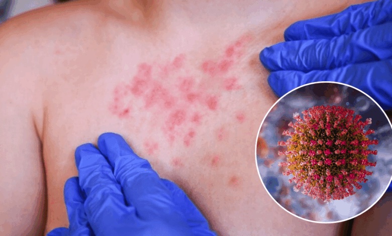 Sarampion1 Secretaría de Salud Nayarit Confirma 25 Casos de Sarampión en la Entidad